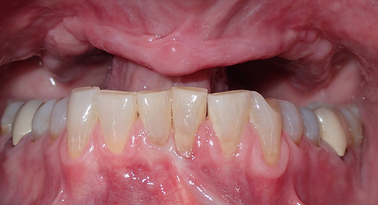 B&A-Teeth-Kathleen-Before