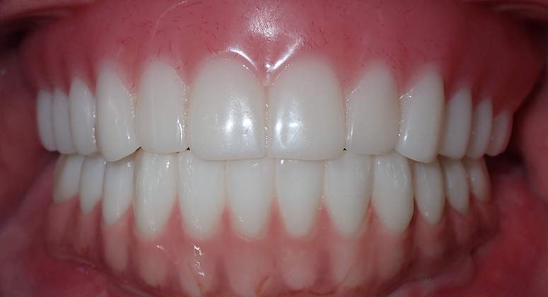 B&A-Teeth-Kelly-After