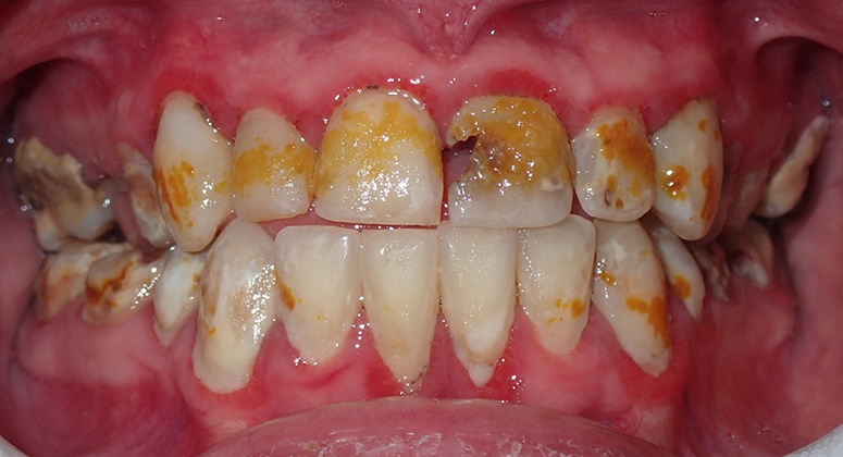 B&A-Teeth-Mason-Before