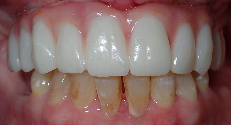 B&A-Teeth-Wendy-After