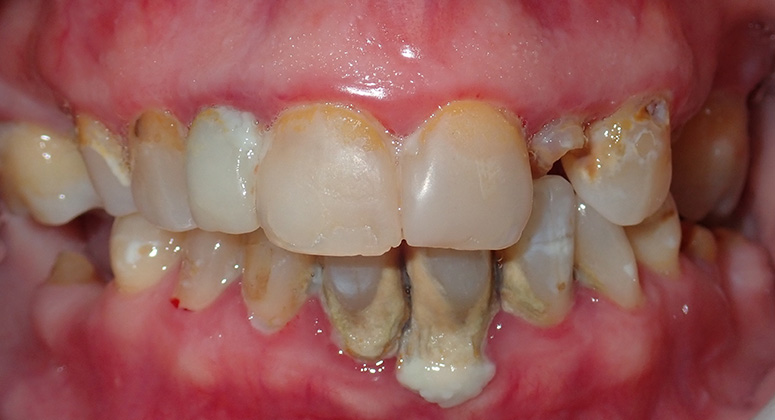 B&A-Teeth-Wendy-Before B&A-Teeth-Wendy-Before