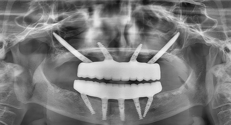 B&A-Teeth-Xray-Alex-After