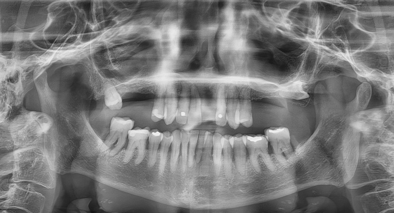 B&A-Teeth-Xray-Alex-Before