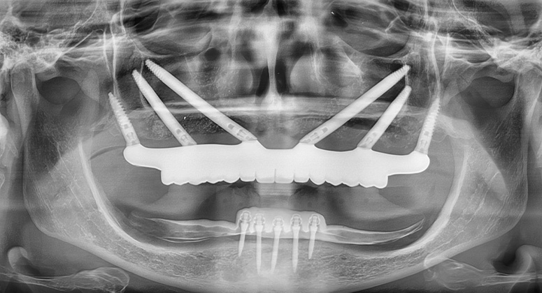 B&A-Teeth-Xray-Amanda 2-After