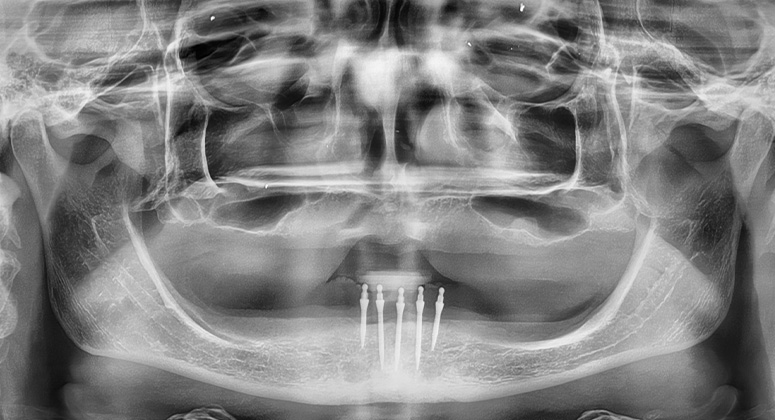 B&A-Teeth-Xray-Amanda 2-Before