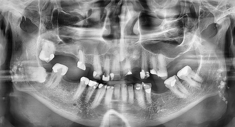 B&A-Teeth-Xray-Dave 3-Before