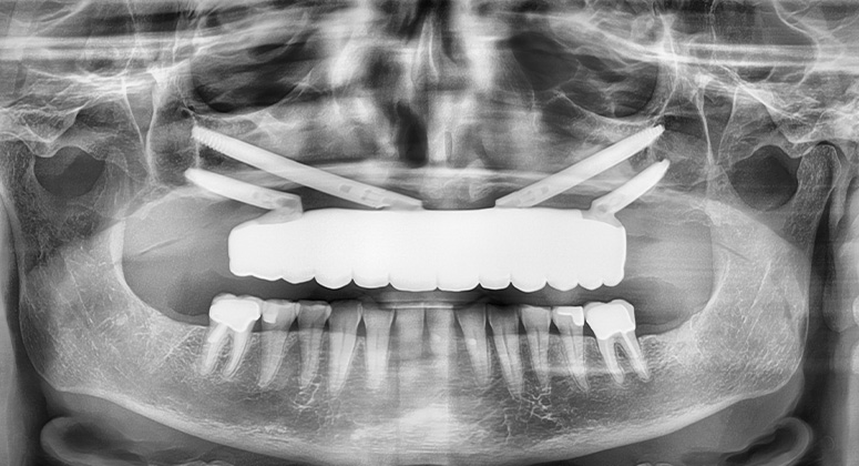 B&A-Teeth-Xray-Kathleen-After