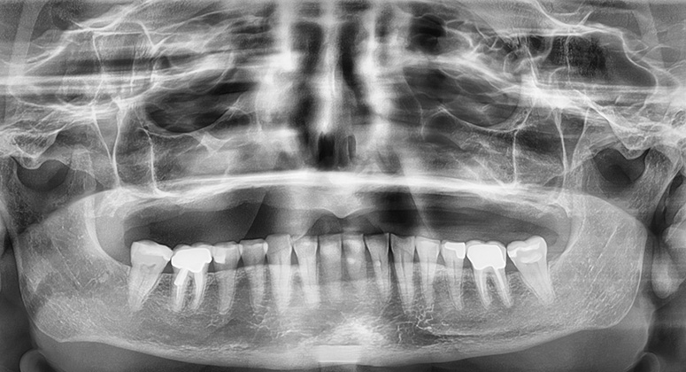 B&A-Teeth-Xray-Kathleen-Before