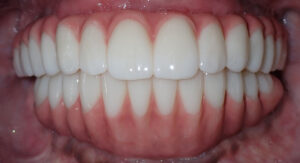 Dawn-teeth-after