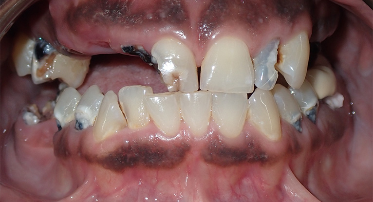 Dawn-teeth-before