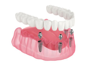 How Long Do Dental Implants Take?