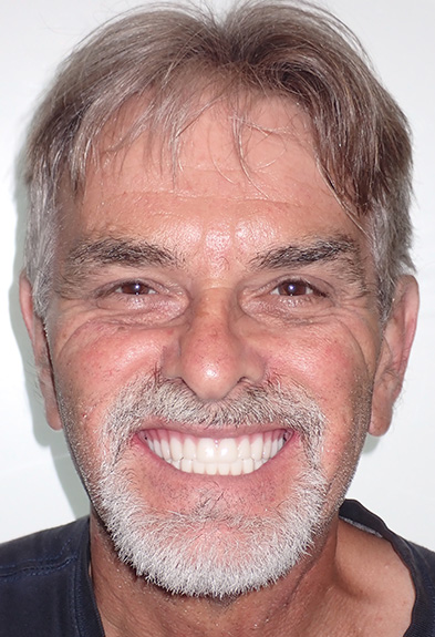 Richard-face-after