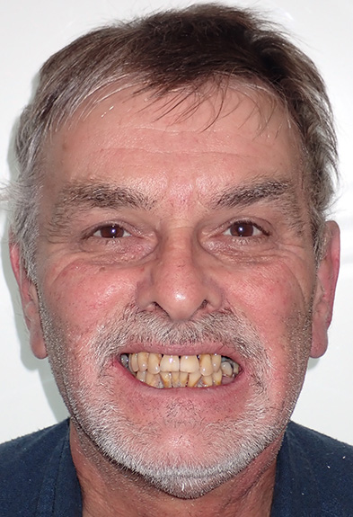 Richard-face-before