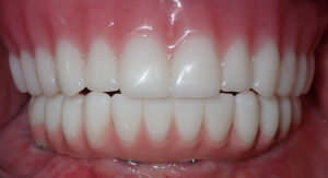 Richard-teeth-after