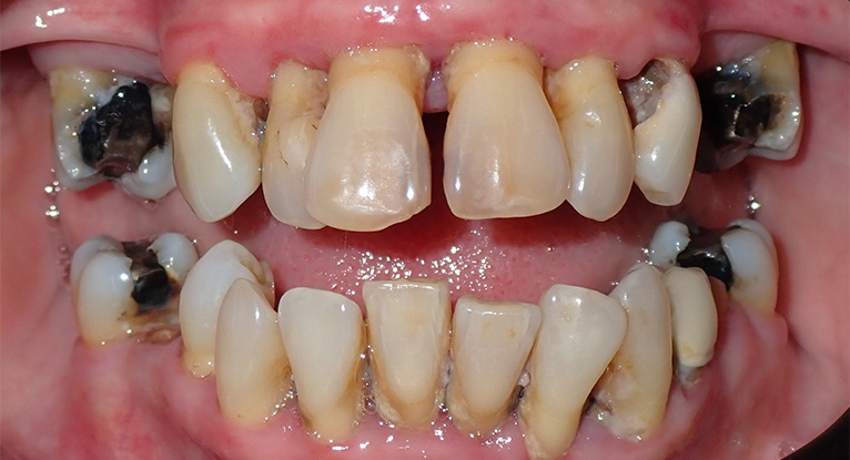 Suzanne-before-teeth