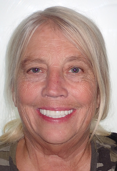 Suzanne-face-after