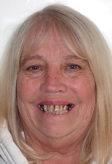 Suzanne-face-before