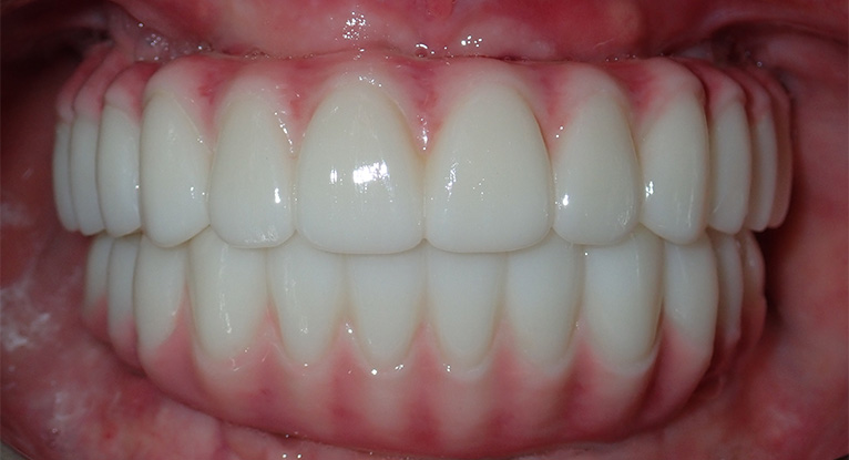 Suzanne-teeth-after