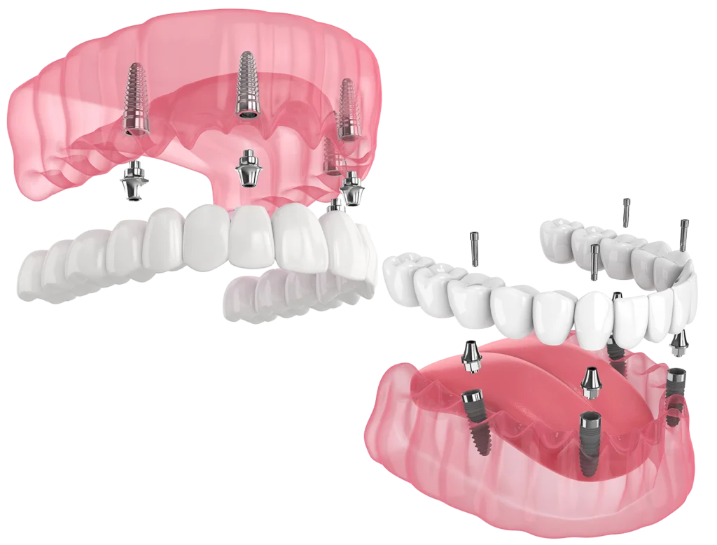 dental implants