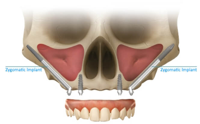 Dr. Igor Kaplansky placing zygomatic implants — ZAGA Center Certified, Gasport NY