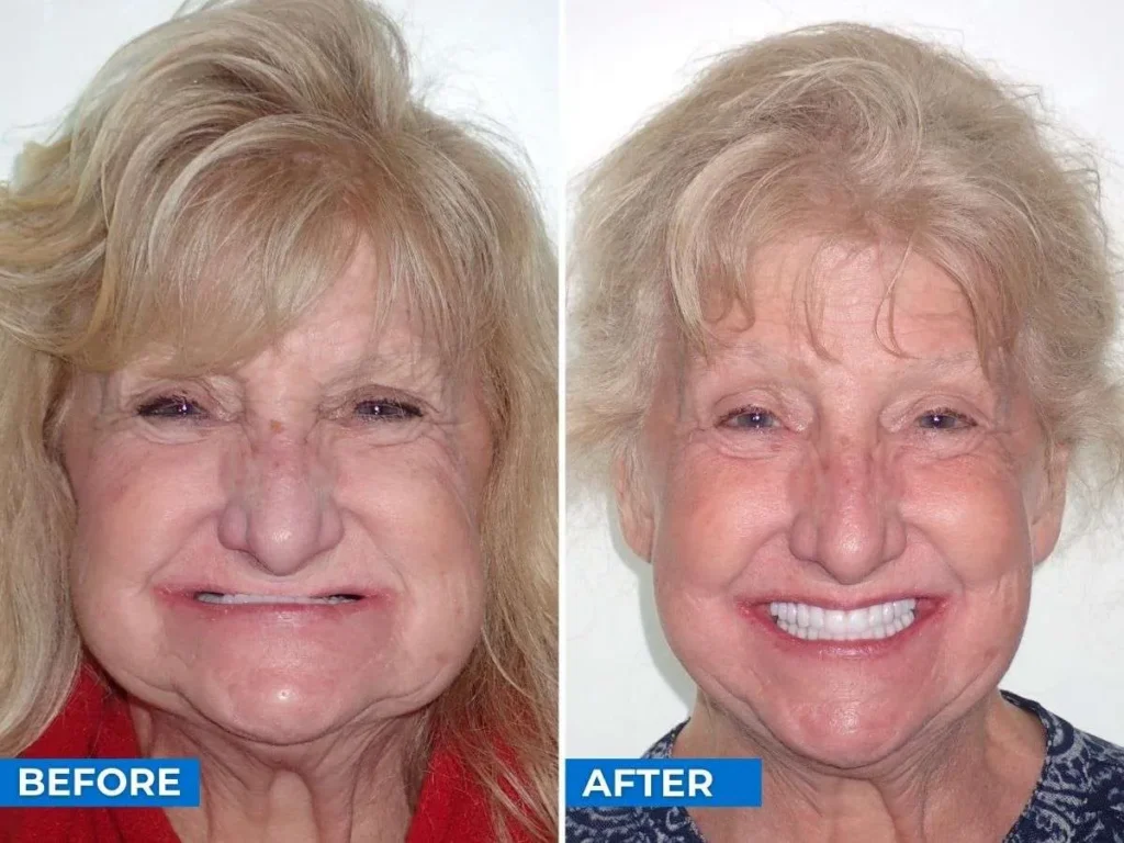 Zygomatic implant patient smiling — Dentistry by Dr. Kaplansky