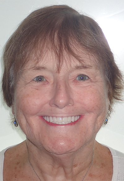 B&A-Face-Pat-After