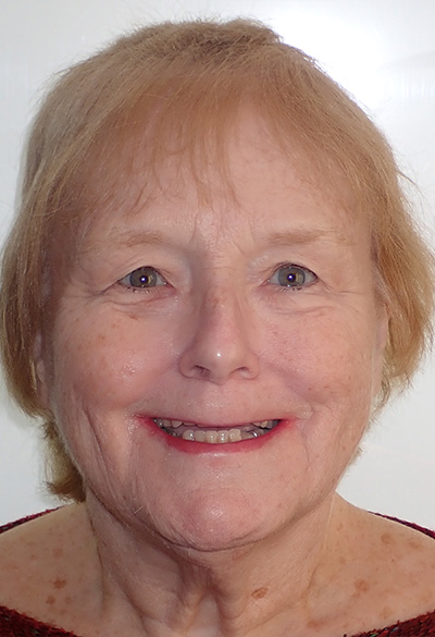B&A-Face-Pat-Before