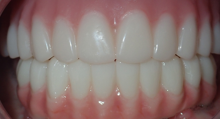B&A-Teeth-Pat-After