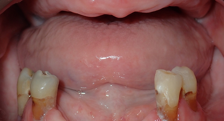 B&A-Teeth-Pat-Before