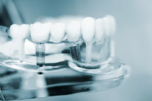 Tooth Replacement