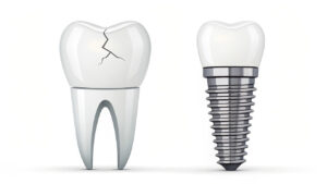 Best Tooth Replacement Options