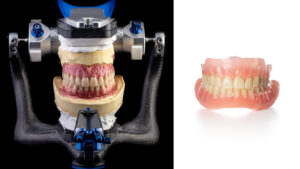 Dental Implants vs Dentures