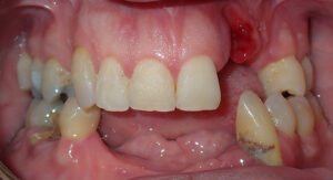 B&A-Teeth-Andrew-Before