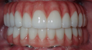 B&A-Teeth-Barb-After