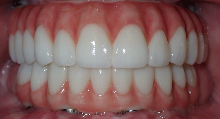 B&A-Teeth-Barb-After