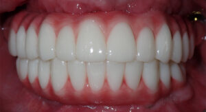 B&A-Teeth-Cheryl 2-After