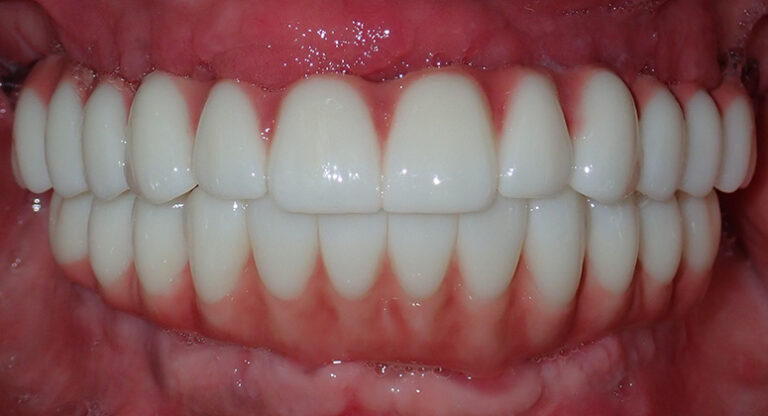 B&A-Teeth-Everton-After