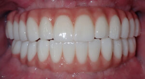 B&A-Teeth-Ian-After