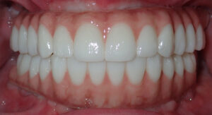 B&A-Teeth-James-After