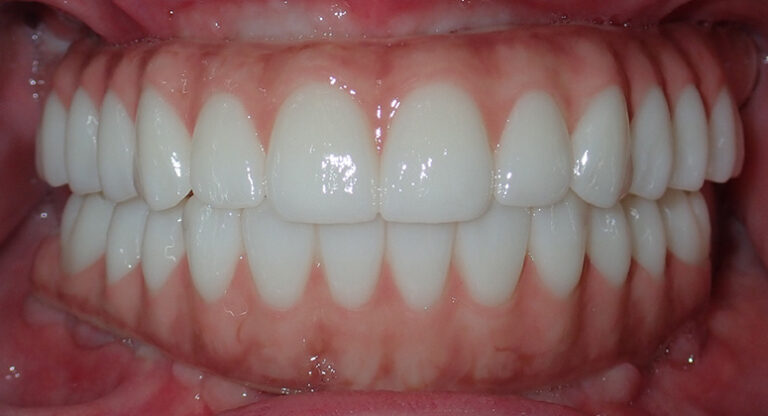 B&A-Teeth-James-After