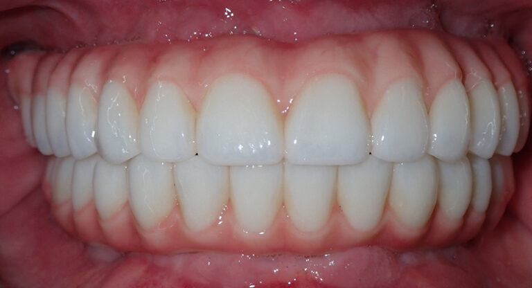 B&A-Teeth-Jeff-After