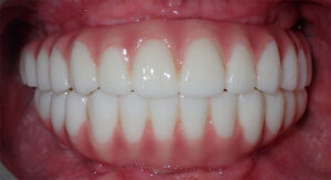 B&A-Teeth-Mason-After