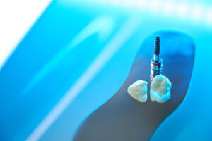 What Are Zirconia Dental Implants