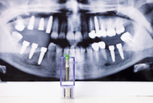 dental-implant-and-x-ray