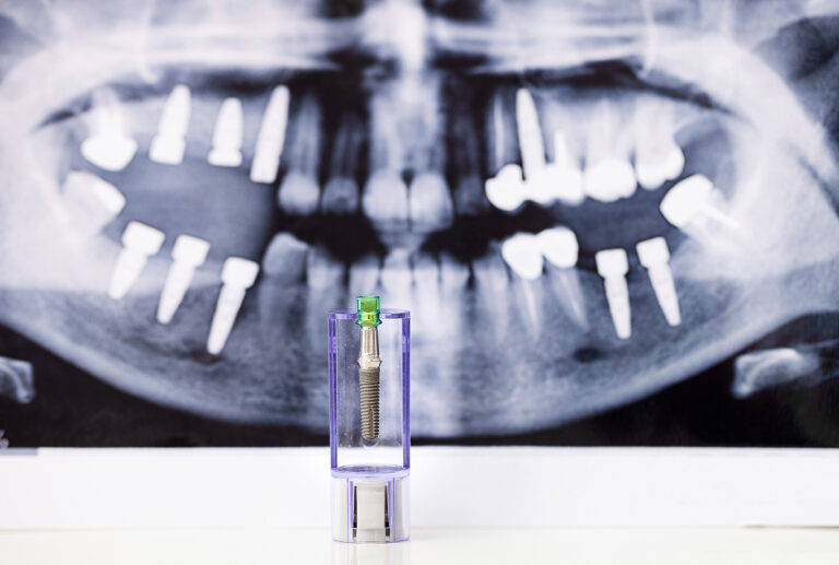 dental-implant-and-x-ray