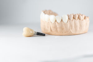 model-of-artificial-jaw-and-dental-implant-2025-03-14-12-51-35-utc