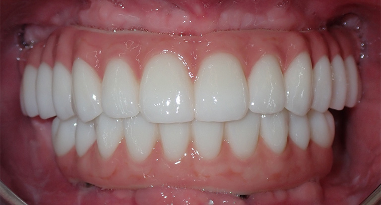Wilda-Teeth-After